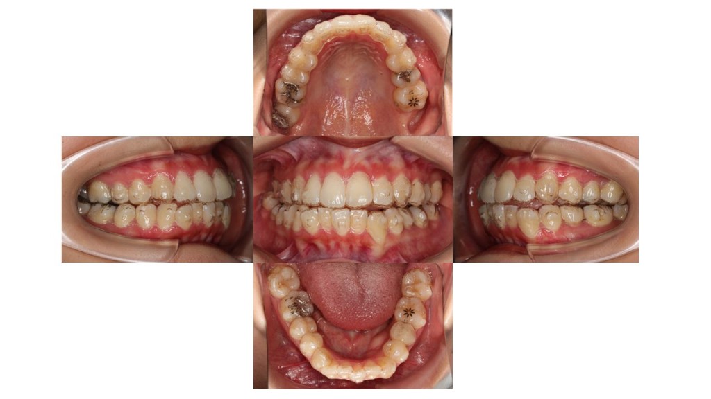 上顎前歯の突出 凸凹 インビザライン マウスピース矯正