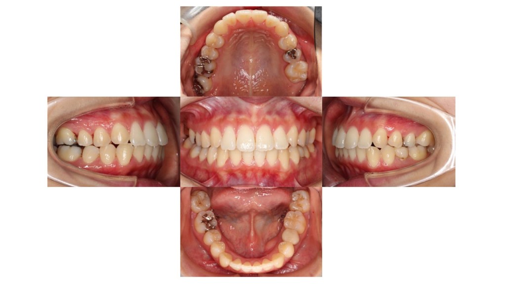 上顎前歯の突出 凸凹 インビザライン マウスピース矯正