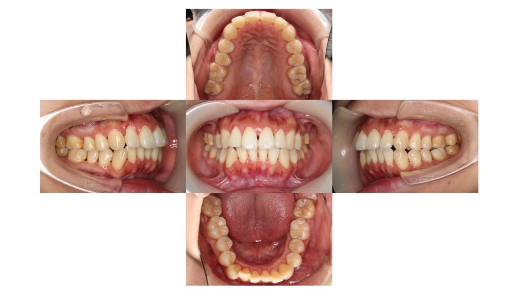 出っ歯改善・裏側矯正