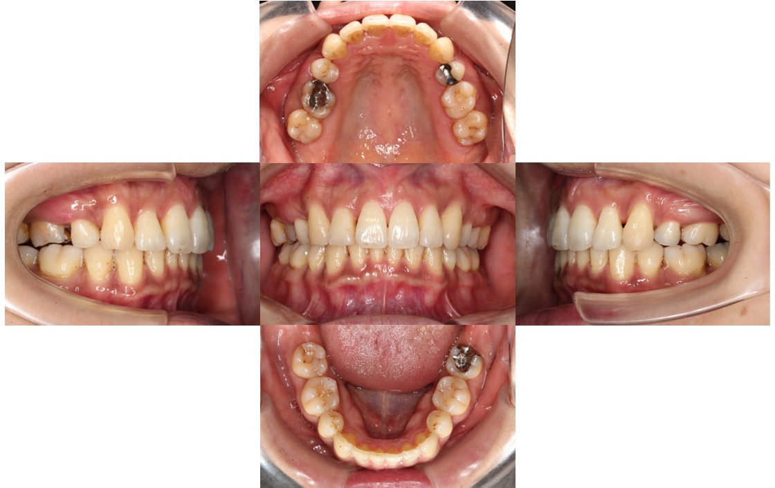 ガタガタ リンガル症例