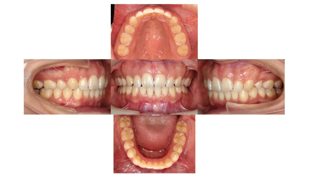 上顎前突ハーフリンガル症例