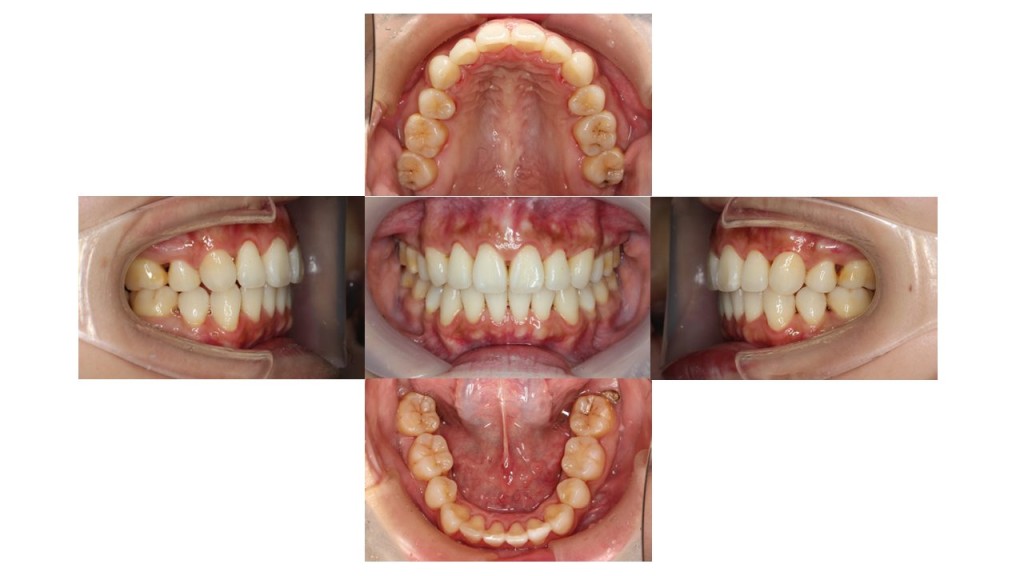 出っ歯改善・裏側矯正