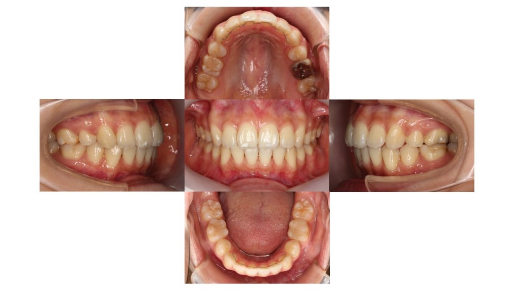 上の歯出ている、裏側矯正症例