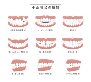 唇を噛む癖で歯並びが悪くなる？