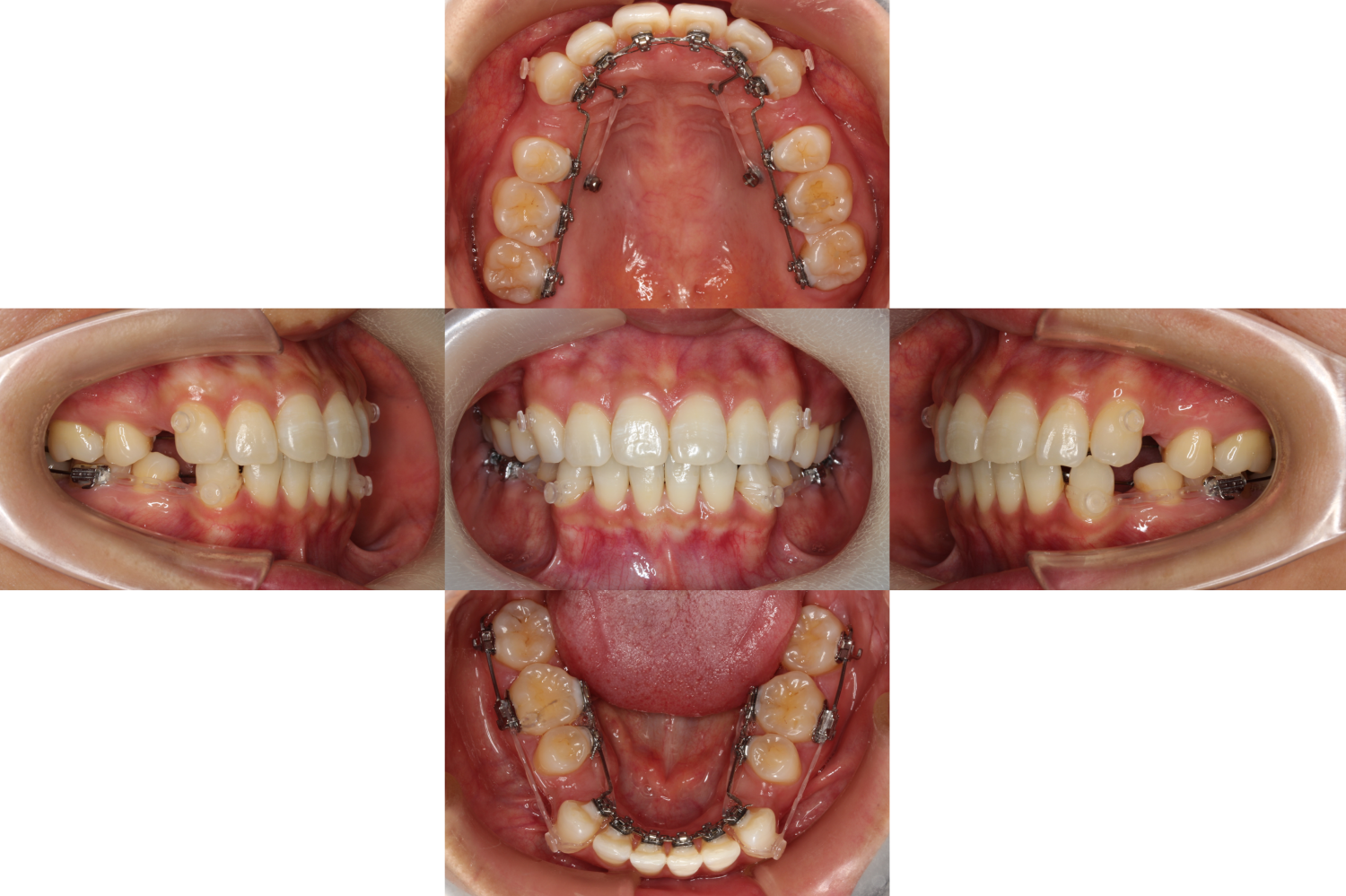 上顎前突・裏側矯正の症例