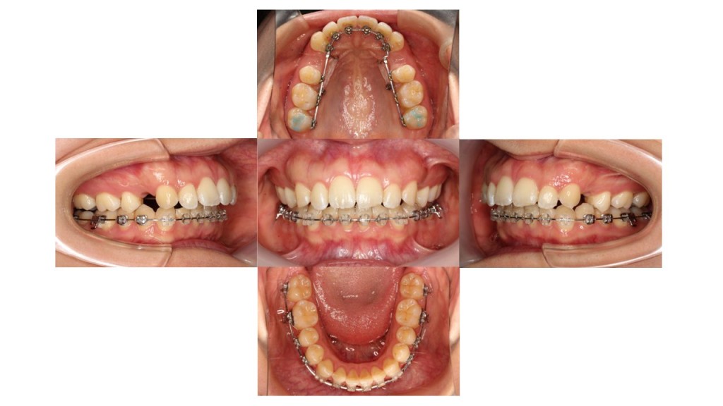 上顎前突ハーフリンガル症例