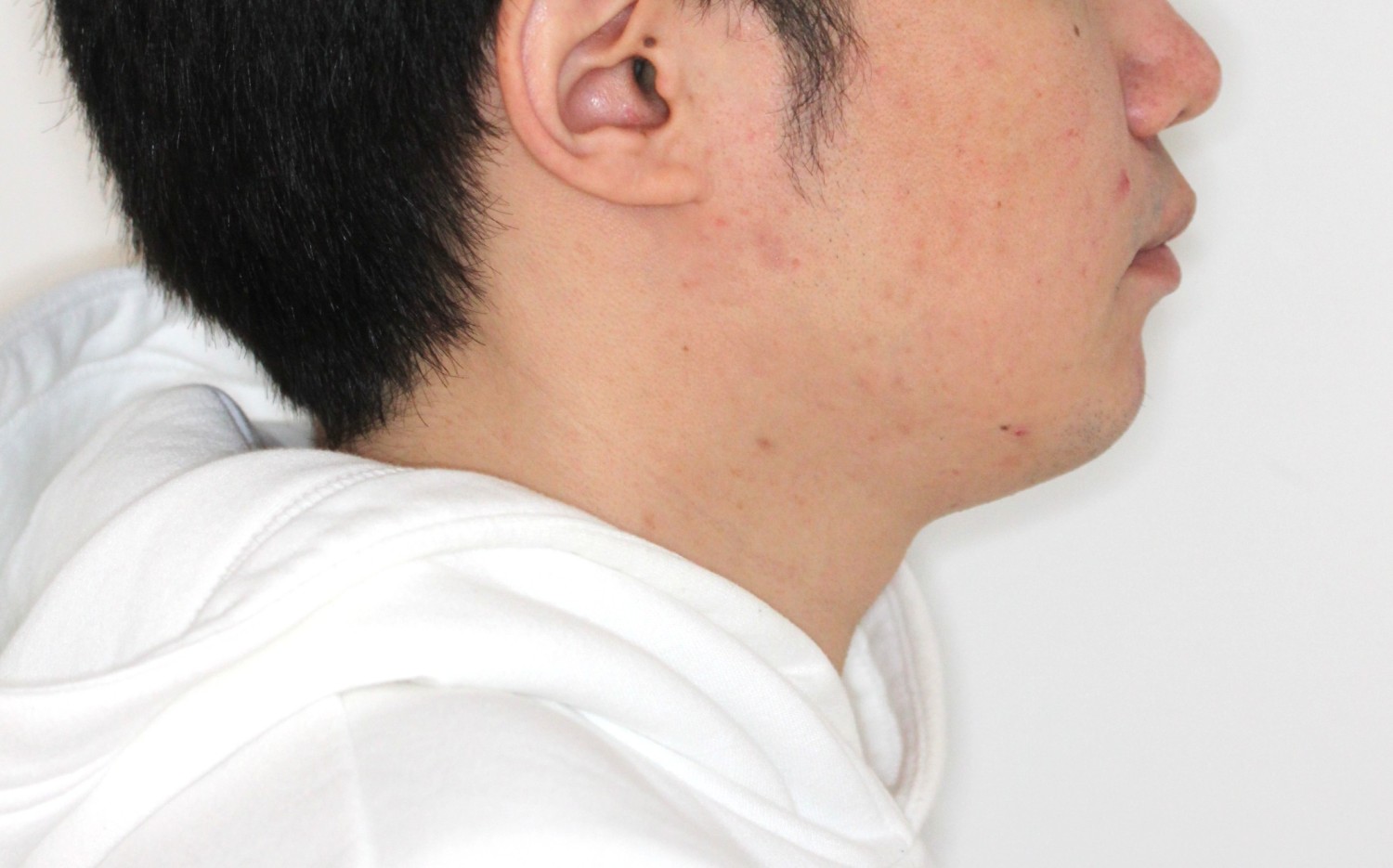 出っ歯・裏側矯正の症例