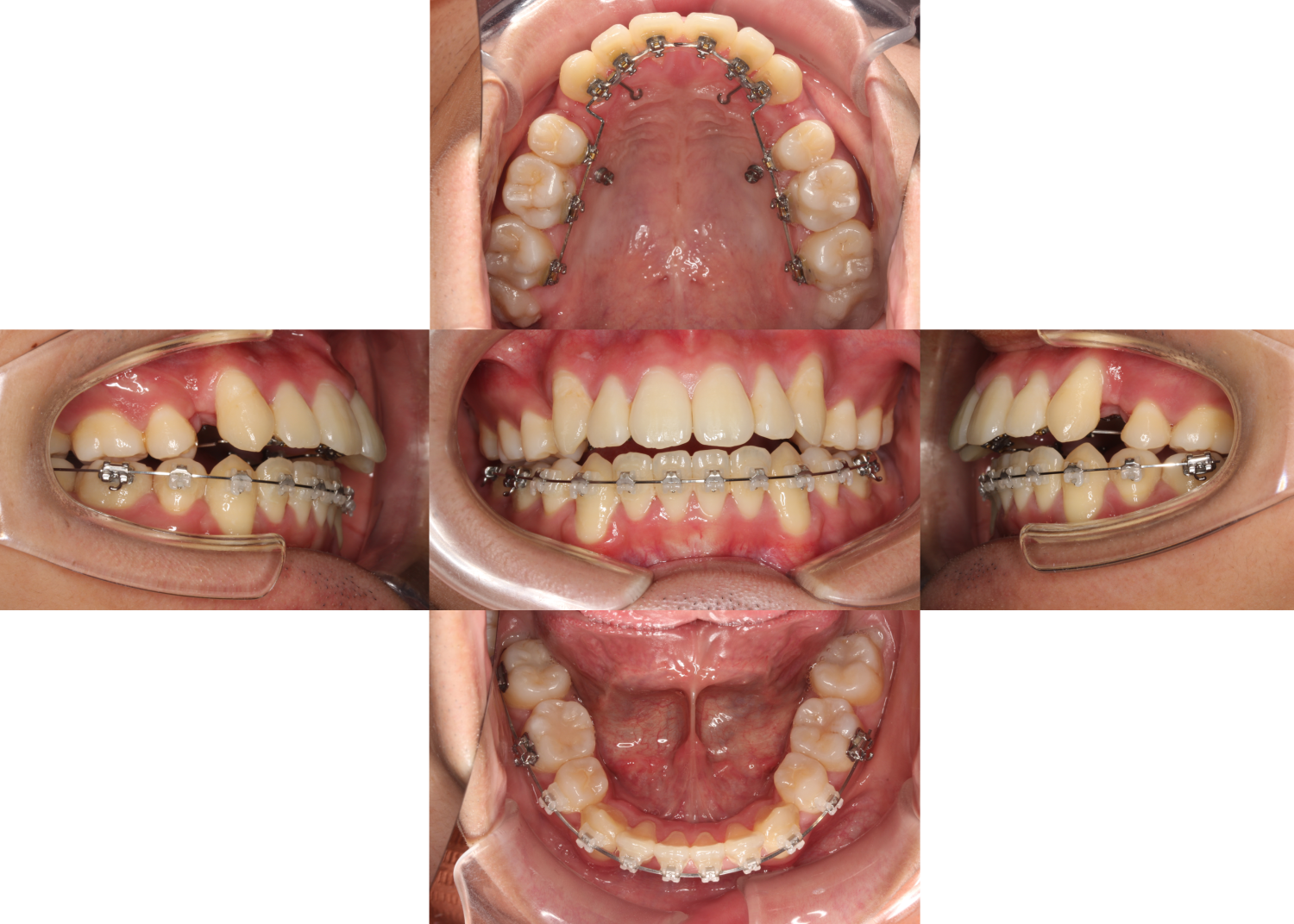 叢生・ハーフ矯正の症例