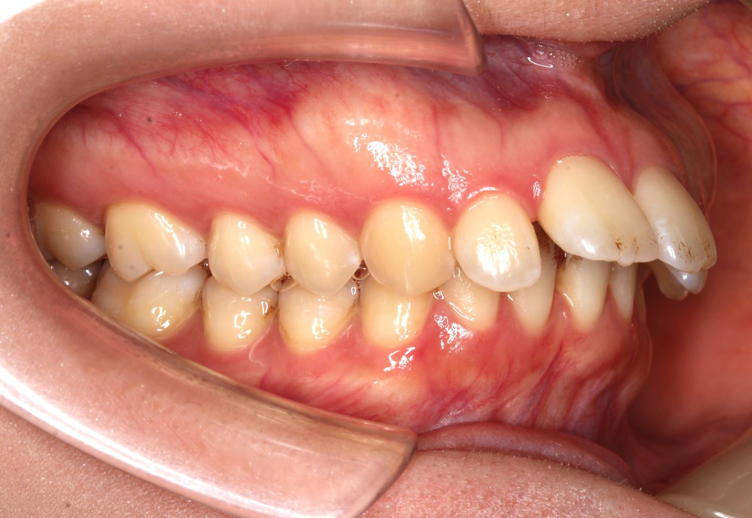 上顎前突ハーフリンガル症例