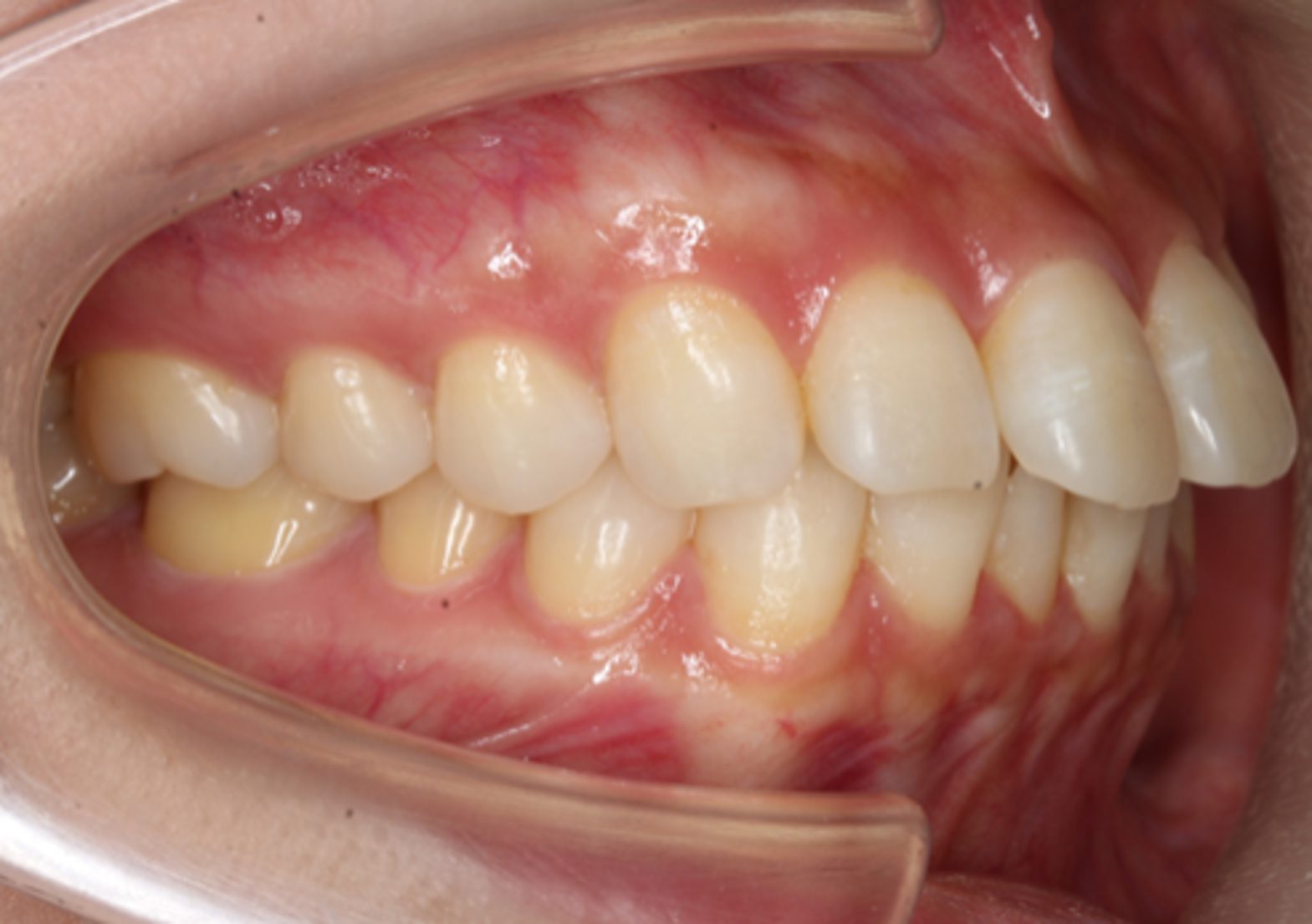 上顎前突・裏側矯正の症例