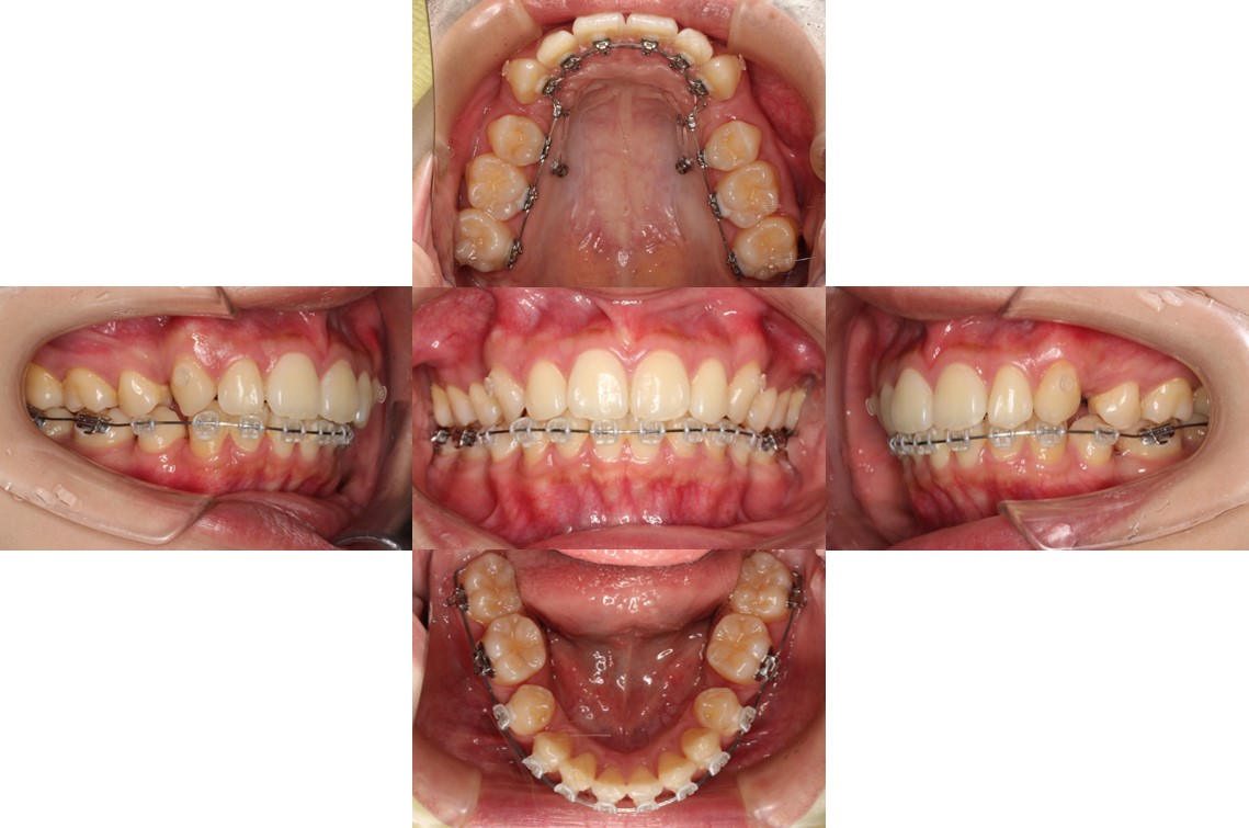 Eライン・ハーフ矯正