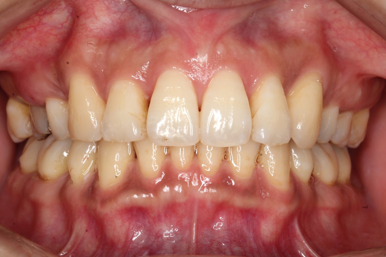 ガタガタ　リンガル症例