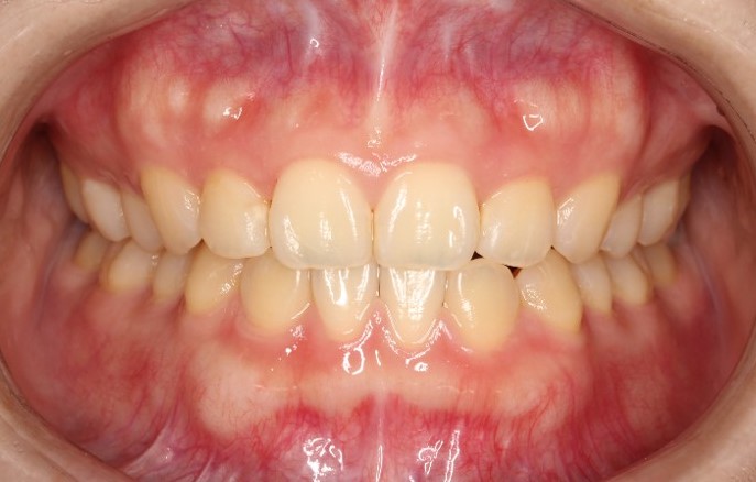 すきっ歯・裏側矯正の症例