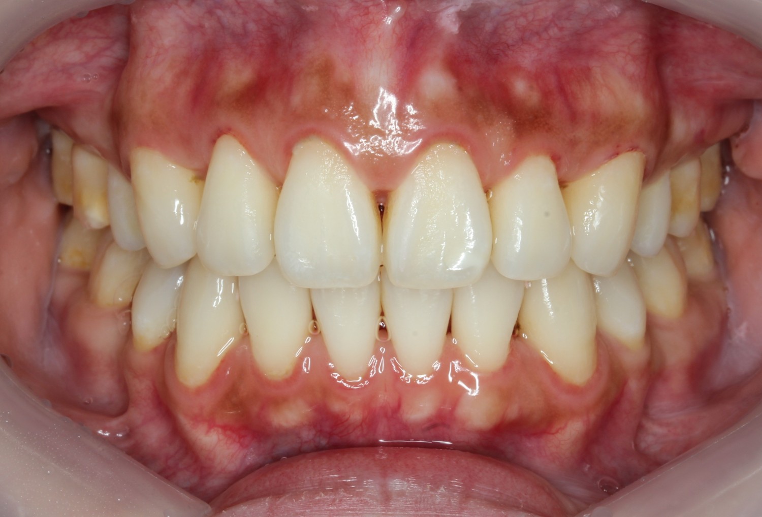 出っ歯改善・裏側矯正