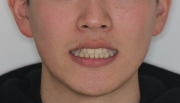 叢生・ハーフ矯正の症例