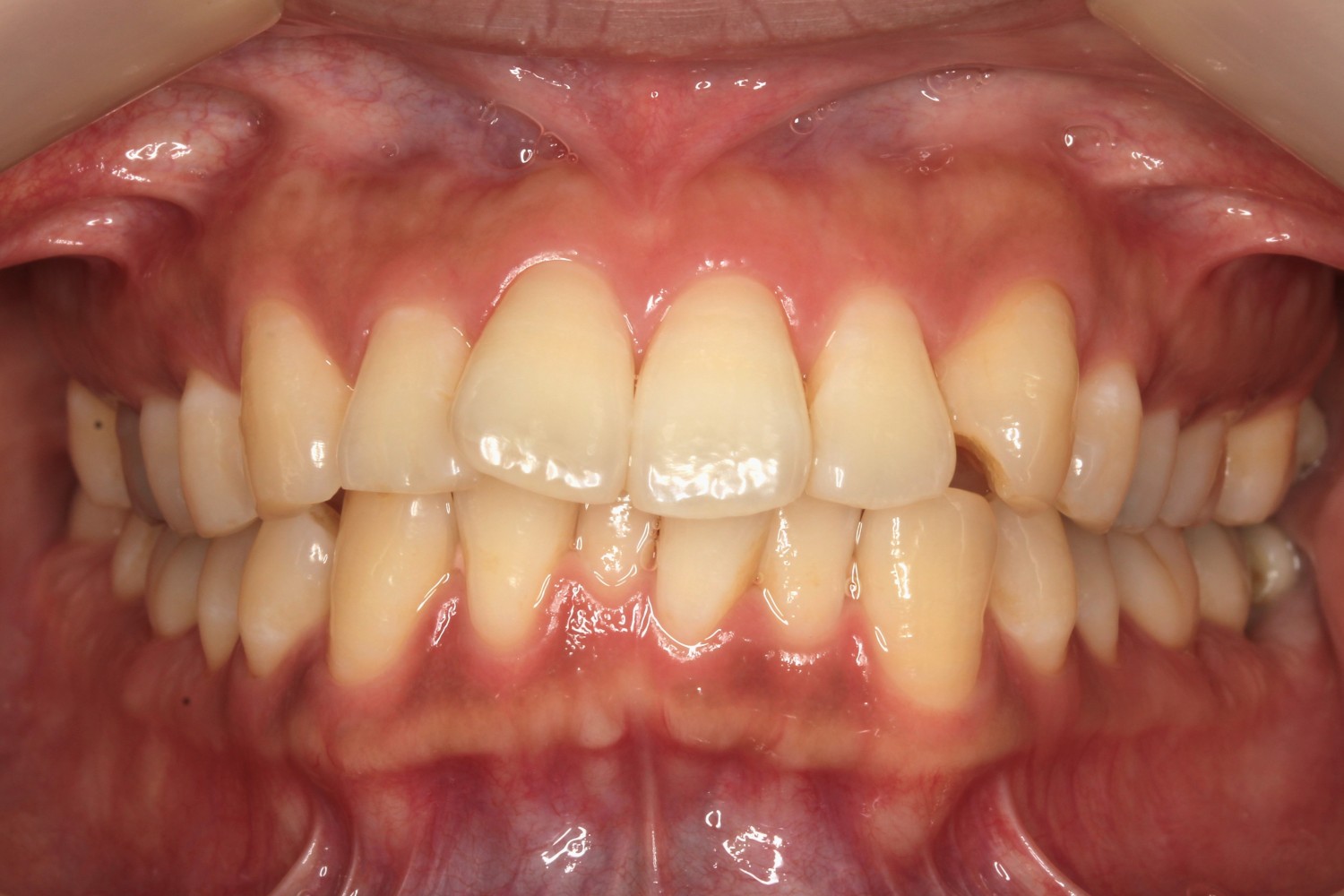 ガタガタ　リンガル症例