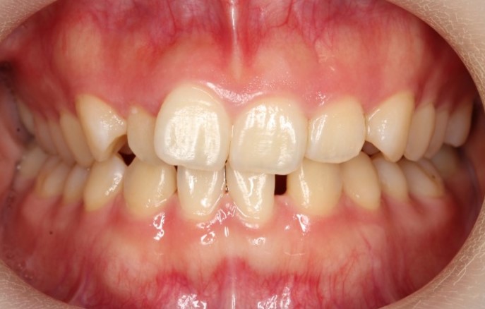 すきっ歯・裏側矯正の症例