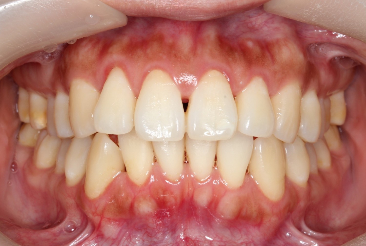 出っ歯改善・裏側矯正