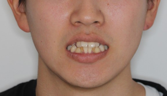叢生・ハーフ矯正の症例