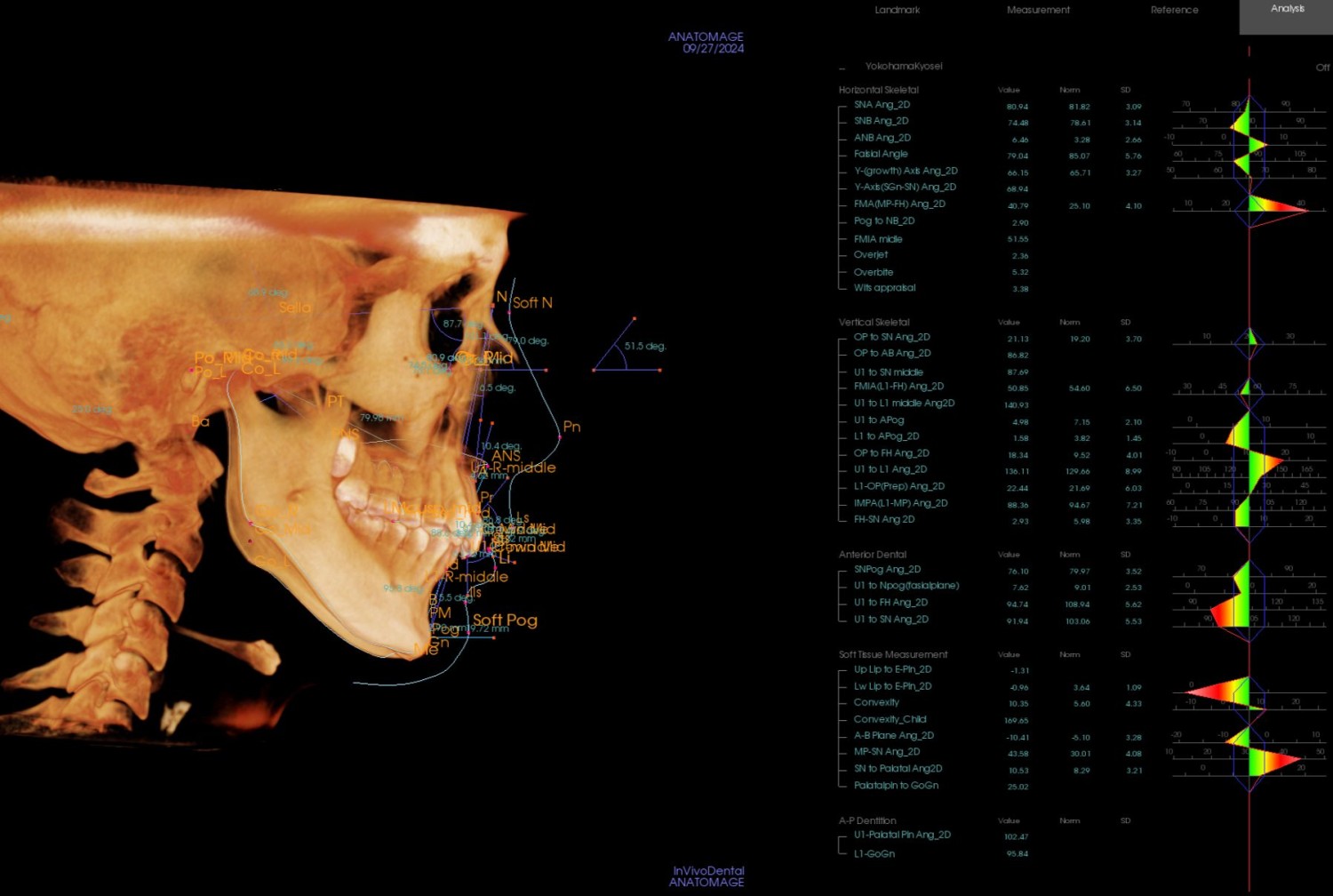 セファロ分析 矯正治療 精密検査