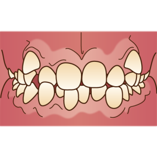 歯並び　噛み合わせ　健康寿命