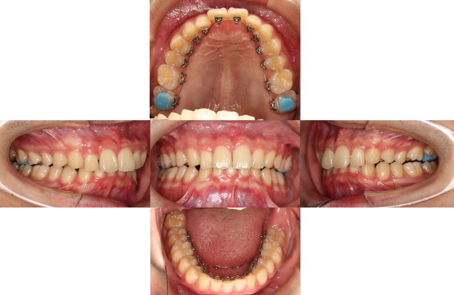 過蓋咬合・裏側矯正の症例