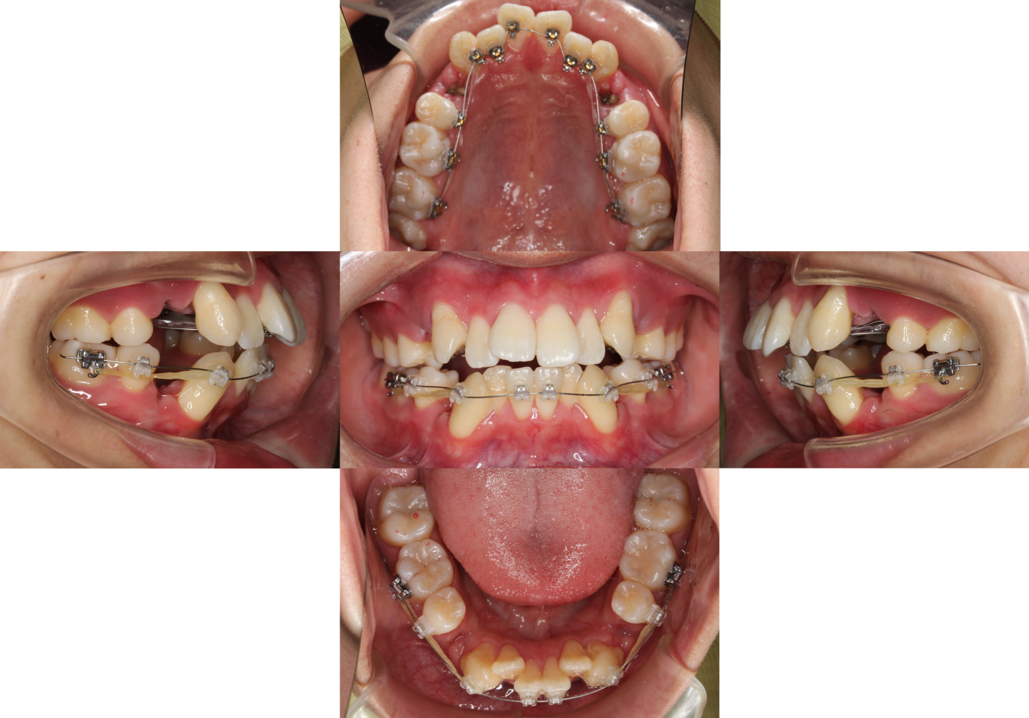 上下叢生・ハーフ矯正の症例