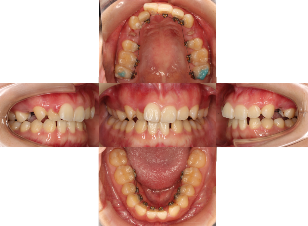 すきっ歯・裏側矯正の症例