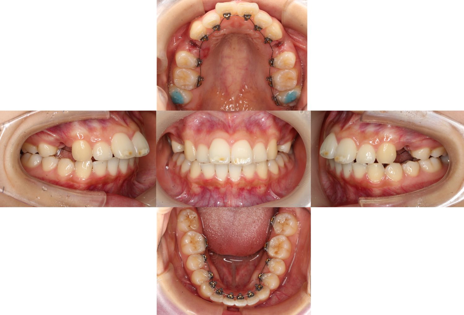 上顎前突・裏側矯正