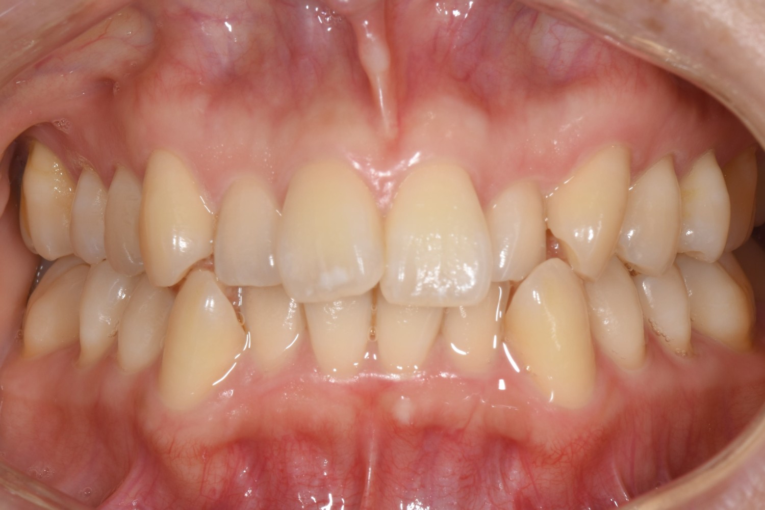 上下前歯の凸凹　マウスピース矯正　インビザライン