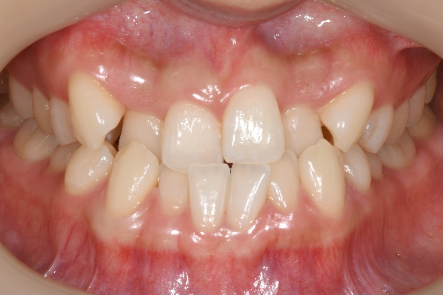 上下の凸凹　噛み合わせが悪い　マウスピース矯正　インビザライン