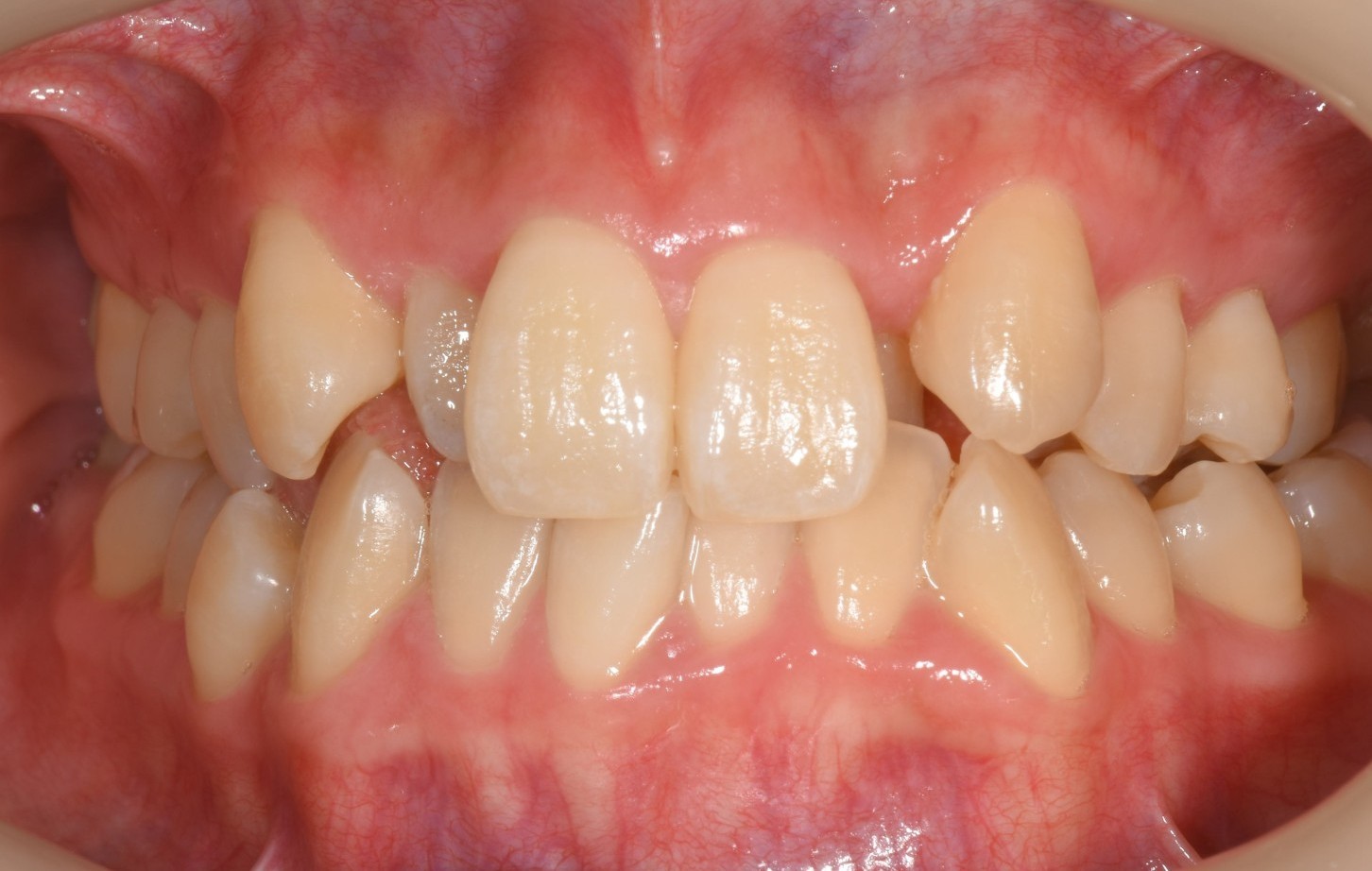 上下前歯の凸凹　マウスピース矯正　インビザライン