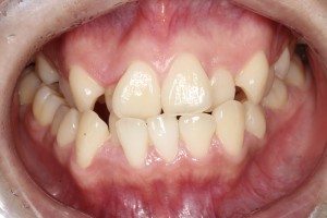 MSE矯正　歯を抜かない矯正　狭窄歯列