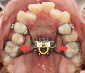 MSE矯正　歯を抜かない矯正　MSE