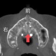 MSE矯正　歯を抜かない矯正　MSE