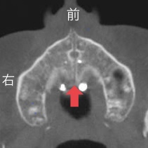 MSE矯正　歯を抜かない矯正　MSE