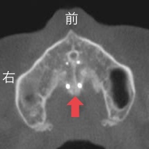 MSE矯正　歯を抜かない矯正　MSE