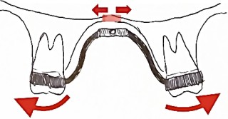 歯を抜かない矯正　拡大装置　急速拡大装置