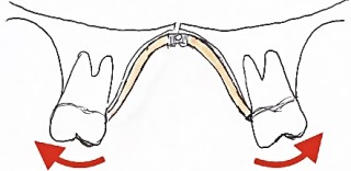 歯を抜かない矯正　拡大装置　拡大床