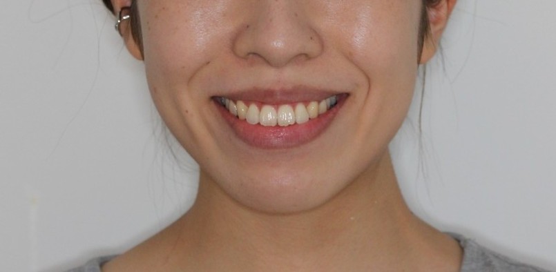 八重歯　前歯の凸凹　インビザライン　マウスピース矯正