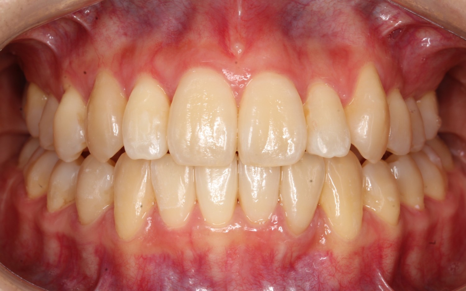 上下前歯の凸凹　マウスピース矯正　インビザライン