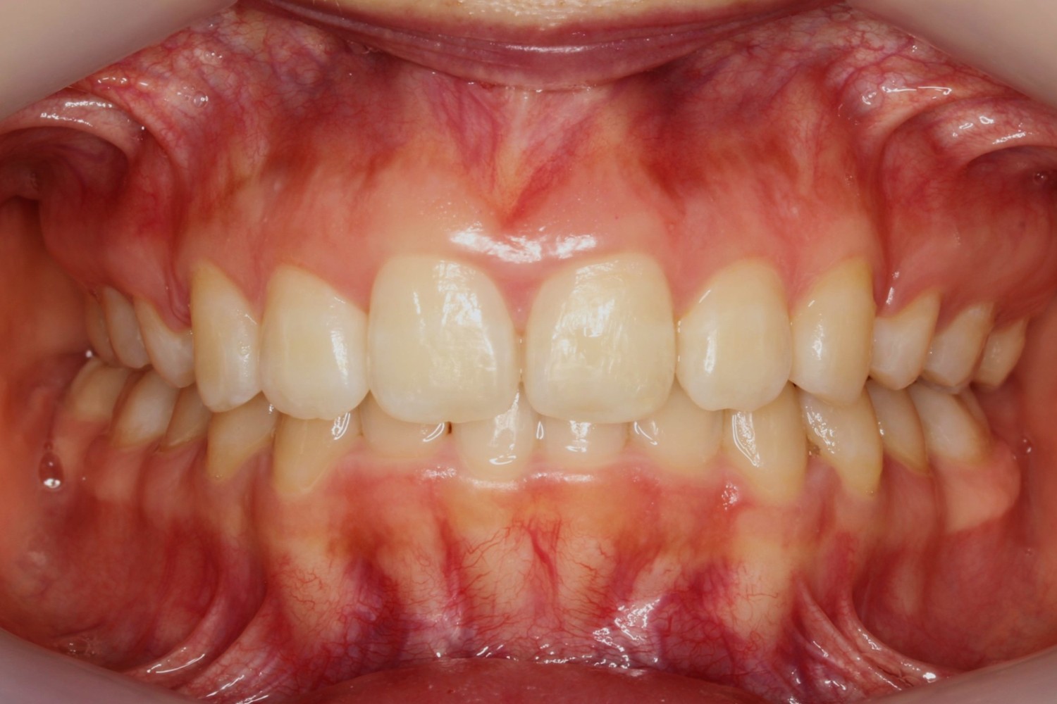 上顎前歯の凸凹　ハーフリンガル