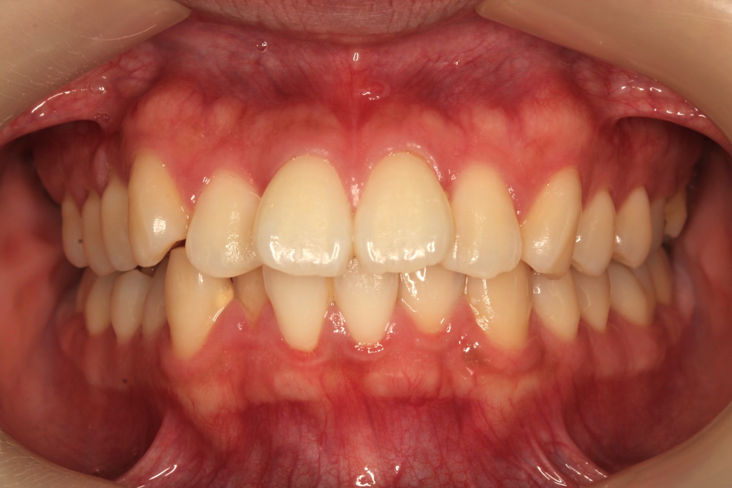 上下の凸凹　マウスピース矯正　インビザライン