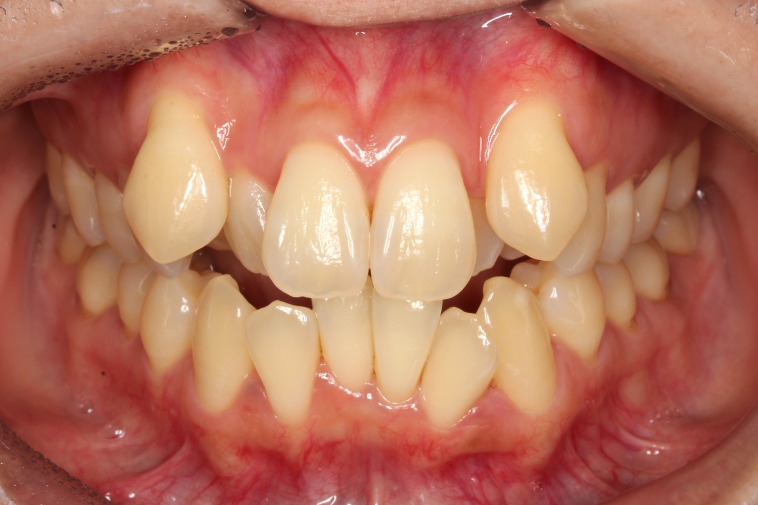上下前歯凸凹　噛み合わせが悪い　ハーフリンガル矯正