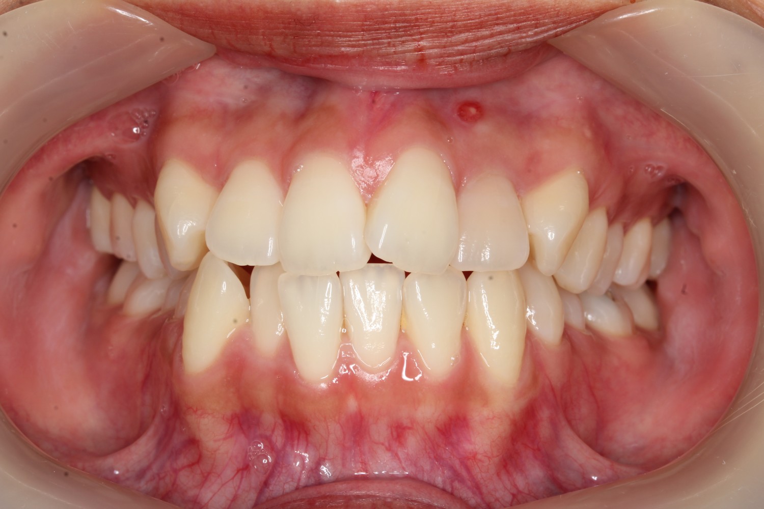 上下前歯の凸凹　インビザライン　マウスピース矯正