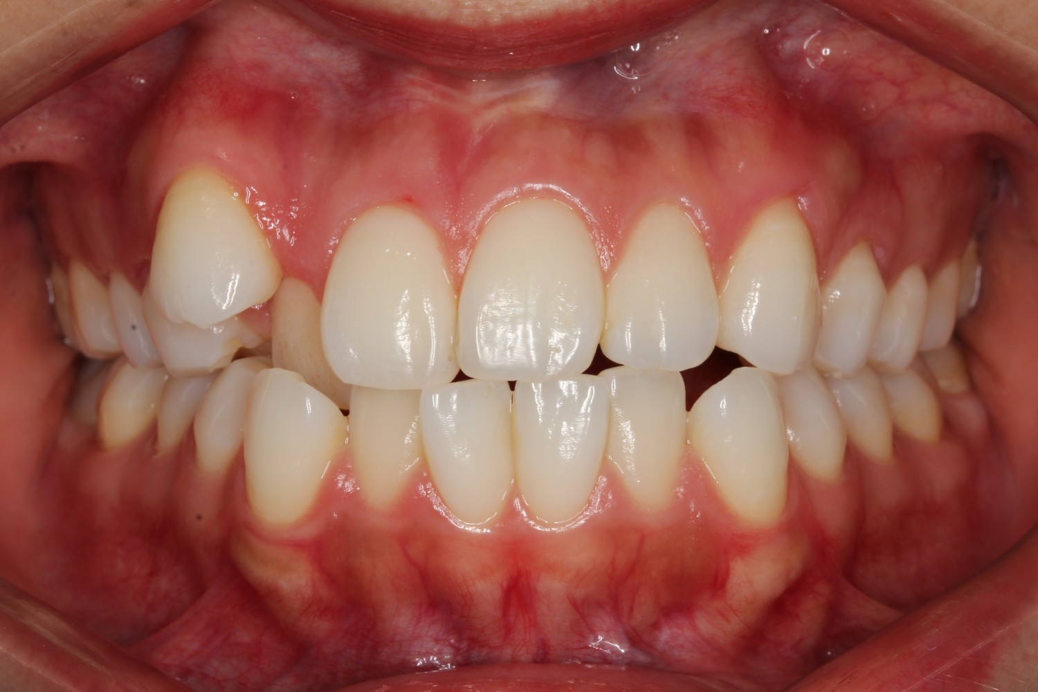 上下前歯の凸凹 インビザライン マウスピース矯正