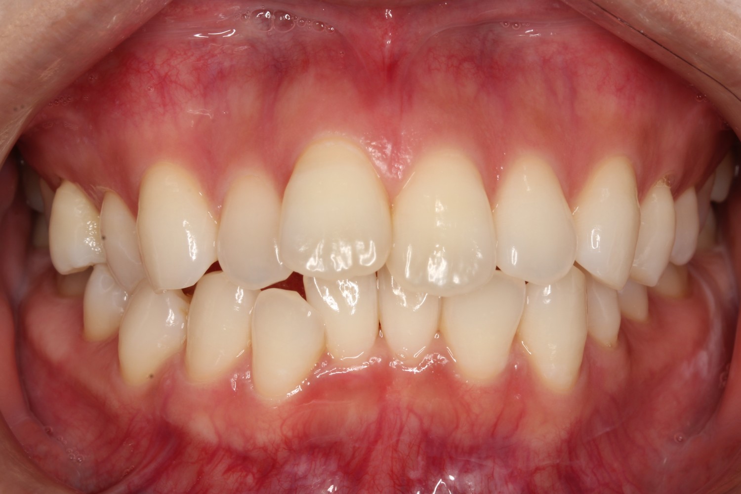 上顎前歯が出ている　マウスピース矯正　インビザライン