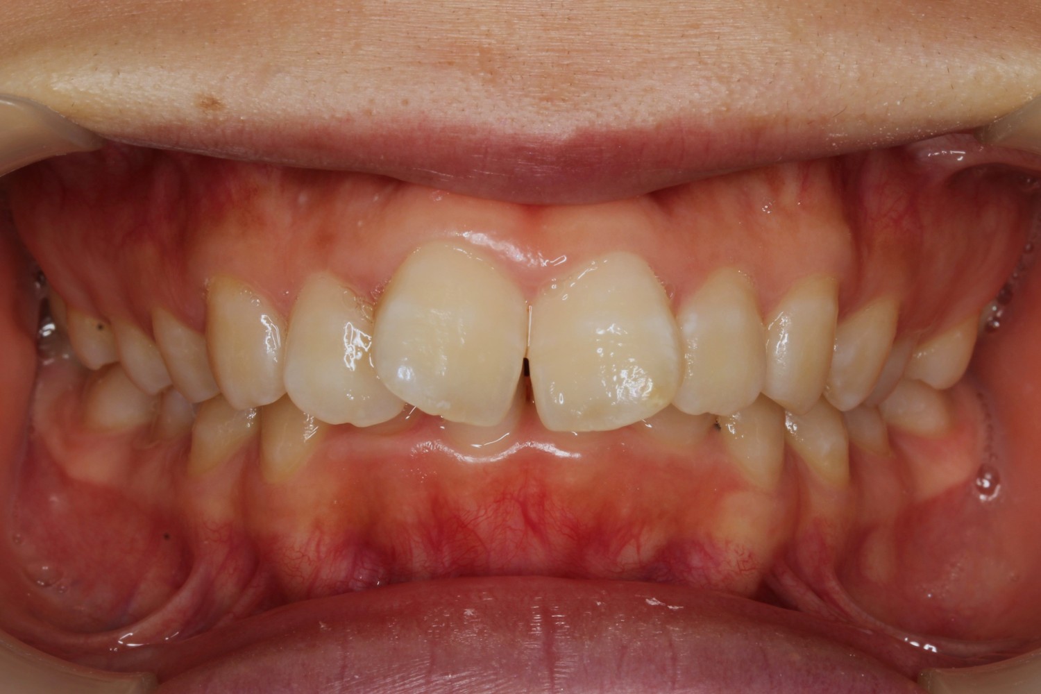 上顎前歯の凸凹　ハーフリンガル