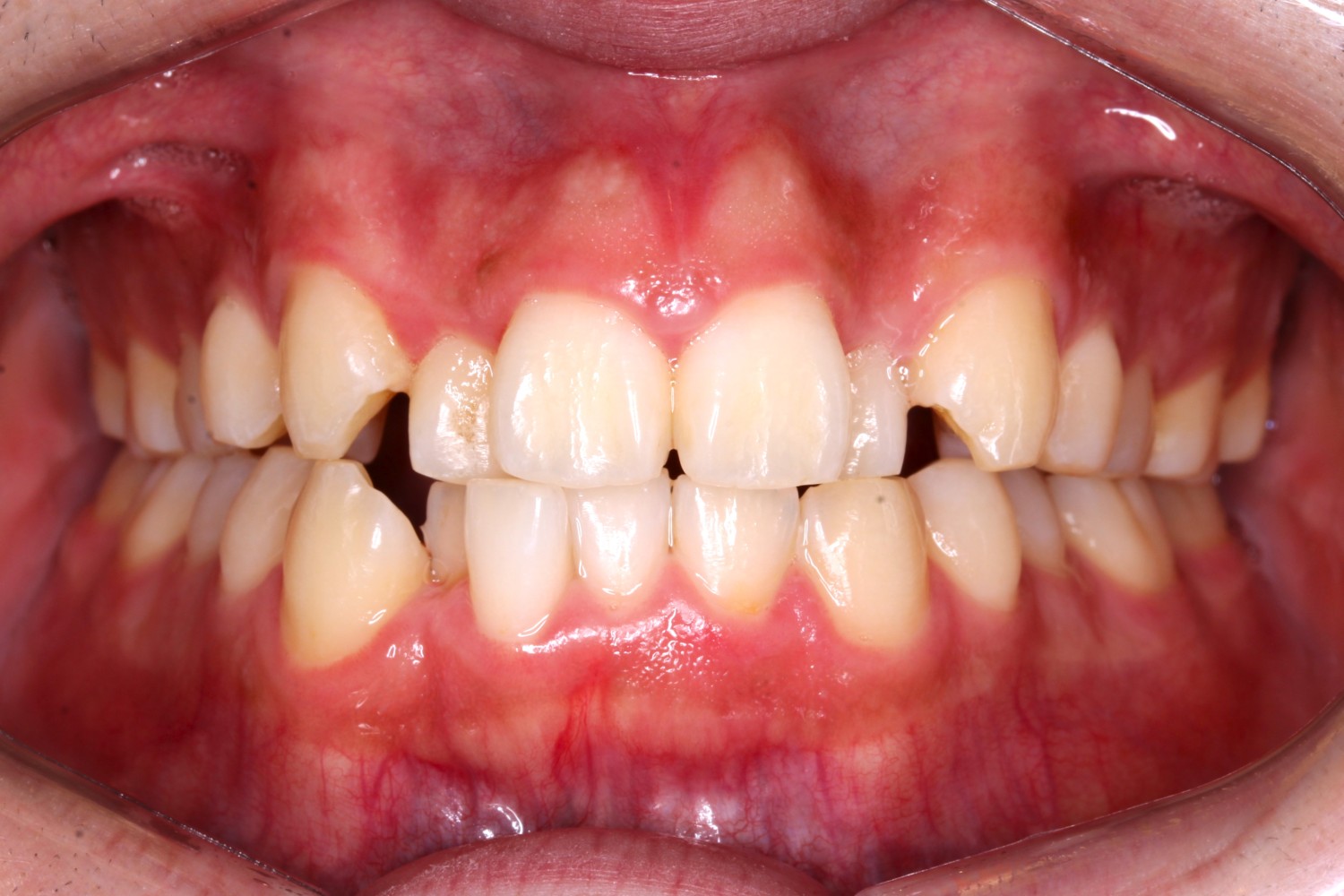 上下の凸凹　上顎前歯が出ている　マウスピース矯正　インビザライン