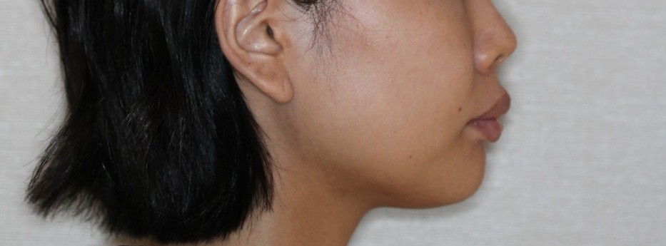 上の前歯が出ている　口元を下げたい